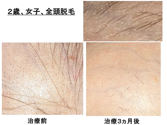 円形脱毛症　病院